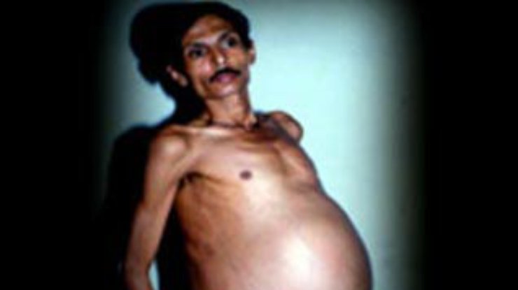 В Индии 36-летний мужчина выносил брата-близнеца