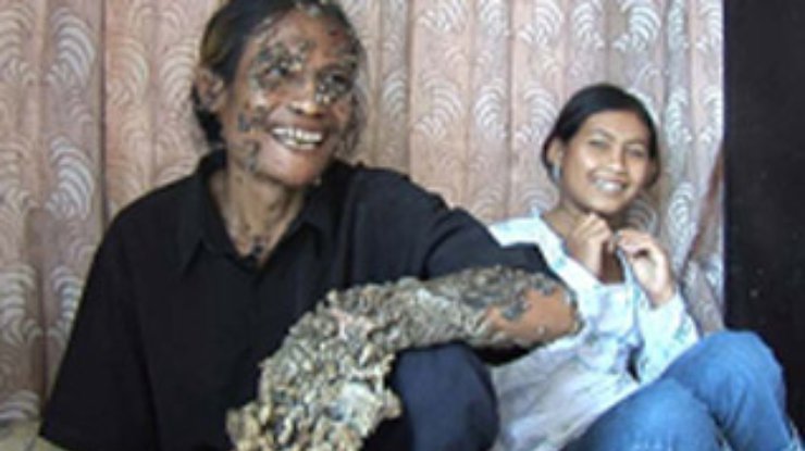 Редкий вирус превратил индонезийца в человека-дерево