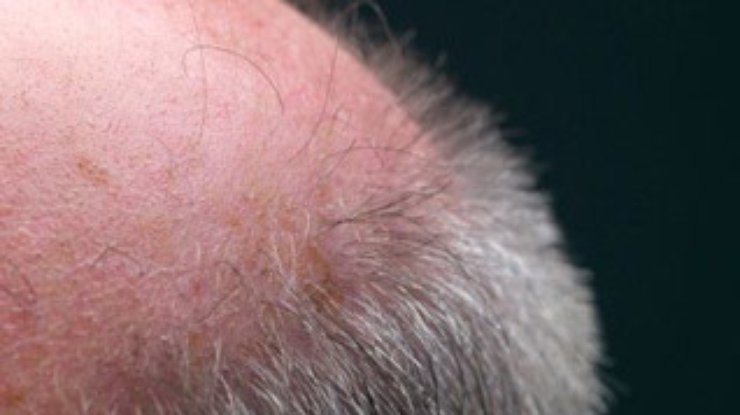 Ученые выяснили причину выпадения волос